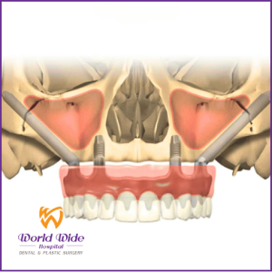 Cấy ghép implant xương gò má (Zygoma Implants)