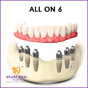 Cấy ghép implant All On 6