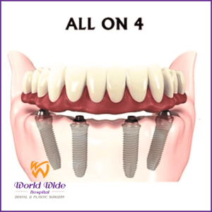 Cấy ghép implant All-On-4