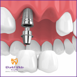 Trồng Răng Implant Vài Răng