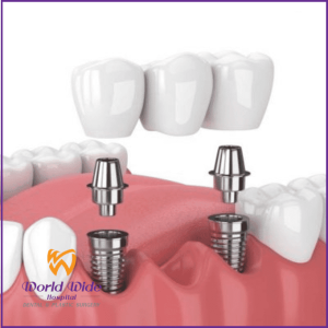 Trồng răng Implant 1 vài răng