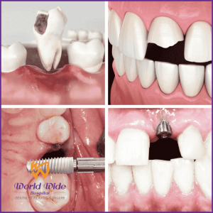 Trường hợp nên trồng răng Implant 1 răng