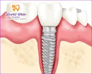 Cấy Ghép Implant Tại Bệnh Viện Răng Hàm Mặt