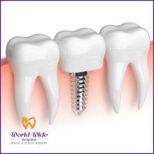 Cấy ghép Implant