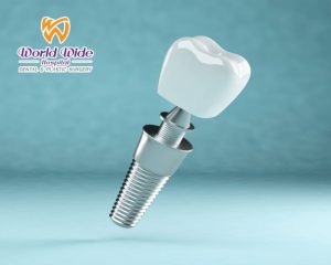 Cấy Implant Bệnh Viện Răng Hàm Mặt: Chi Phí Và Quy Trình